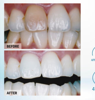 White Enhancement White Enhancement